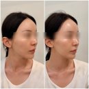 (주)제이엠텍코리아 | [대구 반월당 리프팅] 통증 없는 에어젯 리프팅 제이라인코리아 솔직후기