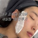 궁한의원 | 대구 피부과 한의원 여드름 패인흉터 새살침 치료 1회차 후기