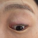 제이유의원 | 아이라인 문신제거 제이유피부과 1차 솔직후기