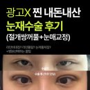 11620-전0-15-1 | 찐 내돈내산 눈재수술 절개쌍꺼풀+눈매교정 대만족 후기 (수술후 당일 ~ 1일차)