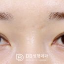 씨에라정동여성의원 | 쌍수재수술후기 꼼꼼하게 봐야 할 점은