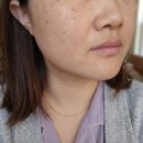 우리힐메디 - 고양시 일산동구 | 메디테라피 톤업크림 바르고 자는 트라넥삼산 기미 잡티 해결 후기