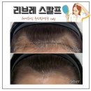 부천 신중동SMP 푸르지오시티 리브레스칼프 헤어라인 반영구커버