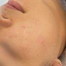 인계동 로라운지 에스테틱 에서 아크네 케어 받고 왔어요