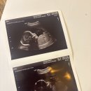 울진군의료원요양병원 | 신/ horseshoe kidney/ 말발굽형 신장/삼성의료원 산부인과/특수 정밀초음파/ 강남차병원 양수검사 후기