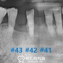 극심한 치주 질환으로 인한 골소실이 있던 분의 임플란트 치료 과정 평택역 치과