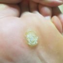 줄 알았던 발바닥 바이러스성 사마귀 냉동치료 후기 1편(약혐주의/일주일 경과/상암동 클린앤미피부과의원)