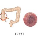 "염증성 장 질환 치료 효과, 정신 건강과 관계있다" 이미지