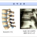 압박골절 이미지