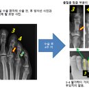 발가락 골절 증상 및 치료 수술 : 엄지 새끼 이미지