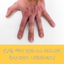 수족냉증과 레이노증후군 중점 진료 안내 [레이노증후군 검사]