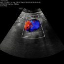 복부 대동맥류(abdominal aorta aneurysm) 이미지