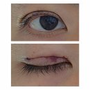 지음약국 | ㄴㅅㅎ 성형외과 비절개 자연유착 쌍수 썰 후기 : 짝눈 남자 쌍수 4편