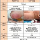 비씨지 | BCG 비씨지 접종 주사 종류 경피용 피내용 가격 효과 접종 후 관리