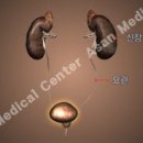 방광암 (Bladder cancer) 이미지