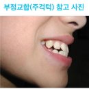 잠실양악수술교정, 수술 대신 치아교정과 턱 끝 수술로 주걱턱이 개선될까요?