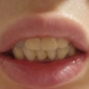 상안유치원 | 30대 쫄보 임플란트 반수면마취 시술 후기