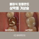 광명사거리 임플란트 전문치과 뼈이식 상악동 거상술 신경치료 크라운 철산역 서울김앤장치과 치료후기