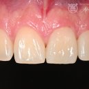 솔라움치과기공소 | 광명 철산 라미네이트 치과, 치간이개, 치아 사이가 벌어졌어요! (자연스러운 치아성형)