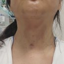 갑상선암 광주 조대병원 로봇수술 후기 회복 멍과 목소리 변화 기록