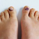 발톱에 "이런 색" 보이면 당뇨 시작입니다 지금 바로 확인하세요. 이미지