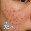 함께하는약국 | 약국 여드름 흉터연고 내돈내산 후기와 효과적인 루틴