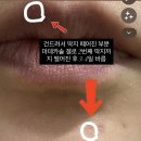 차오름약국 | 성인 수두 흉터 관리 -약국 연고