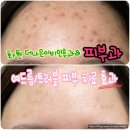 화원초등학교 | 대구 화원 더나은이비인후과-피부과 여드름/트러블 치료 및 관리 2달 차 리얼 후기!