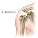 상동정형외과의원 | 약대동 정형외과 밤에 더 아픈 오십견, 어떻게 치료할까요?