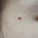 더니버스성형외과의원 | 점제거 수술 서울 성형외과 리스트, 비용 정리 (선천성 모반)