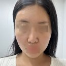 청담동 피부과 온다리프팅 8만줄 내돈내산 후기