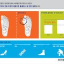 무지외반증 염증 원인 수술 병원 이미지