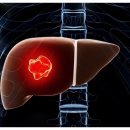 지방간의 진단과 관리 이미지