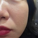 다정한의원 | 연말 일상:) 지긋지긋한 편평사마귀 끝장내기! 서면 한의원 편평사마귀제거 솔직 후기