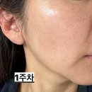 압구정리프팅 볼뉴머 후기, 리프팅 솔직 효과, 가격, 통증유무, 300샷 후기