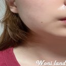 보려함(feat.💸돈💸아끼세요.피부에 양보하세요.)리프테라 svc 2회차 + 윤곽주사 2회차 + 턱 보톡스 1회차