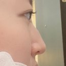 복코찜이 | [내돈내묶] 코끝묶기(복코 성형 / 연골묶기) 후기 (1년 넘은 노즈빔 후기)