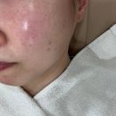 구암동245 | 대전 유성구 좁쌀여드름 압출 이유에스테틱 피부 수분 관리 후기