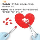 심내막염 이미지