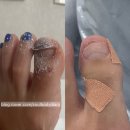 레푸스n바바 | 들린 엄지발톱 부산내성발톱전문 레푸스수영점n바바네일에서 교정하기