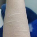 휴먼레이저 | 강남 수술흉터치료 전문병원 흉터제거 내돈내산 울트라펄스앙코르 봉합흉터레이저후기 1회차