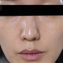 미뉴얼 | [동탄피부과 쥬베룩 후기] 눈밑꺼짐 시술 내돈내산! 효과·통증·가격 총정리 (미뉴얼의원동탄)