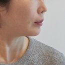 신논현 피부과 팔자주름 잼버실 쥬베룩 받고온 후기