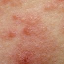 (주)서원약품 | 🪳 청주 서원구 다세대주택 먼지다듬이 출몰 퇴치 방역 후기 | 미소창방역