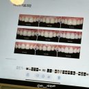 무삭제 라미네이트 ‘미니쉬’ 잇몸성형 내돈내산후기