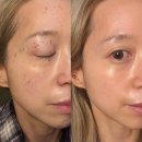 에스와이바른피부과의원 | 마곡피부과 발산역 원데이 색소 프로그램 기미 주근깨 통증 딱지 후기 기록