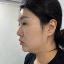 링크 | 강남역 피부과 볼링크4D 후기를 낋여왔어요