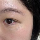 보명약국 | 편평사마귀 제거 1주차 후기 (얼굴 + 목 500개 넘는 듯)