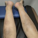 아랫두대경로당 | 화폐상습진완치, 이 2가지를 해결못하면 언제 나을지 모릅니다.(한의원 원장이 직접 쓴 글)