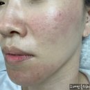 씨엔씨 메디칼 | 프락셀통증 프락셀효과 서초역피부관리 CNC뷰티 후기